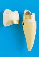 Restauración de Corona