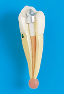 Relleno del Conducto