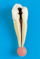 Contamination of root canal