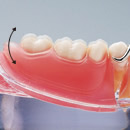 Prótesis dental