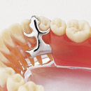 Dental Prosthesis