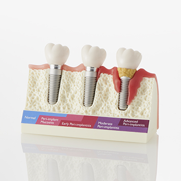 ENFERMEDAD PERI-IMPLANTARIA [PE-IMP004]