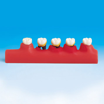 MODELO DE ENFERMEDAD PERIODONTAL [PE-PER002]	