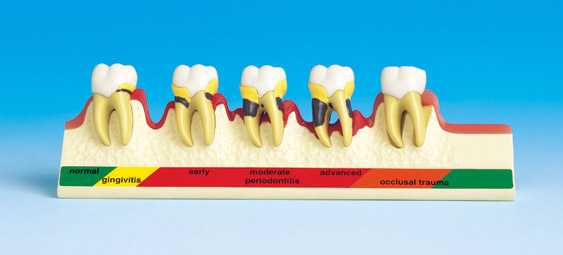 MODELO DE ENFERMEDAD PERIODONTAL [PE-PER002]