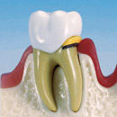 Comparación de condicion sana y gingivitis