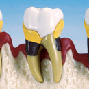 Periodontitis intermedia