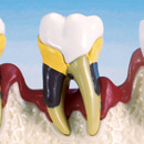 Periodontitis severa