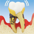 Periodontitis severa