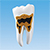 MODELO DE ENFERMEDAD PERIODONTAL [PE-PER014]