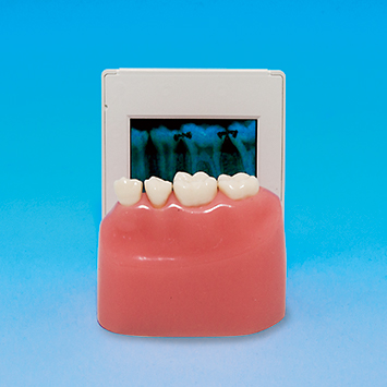 MODELO DE DETECCIÓN DE CARIES INTERPROXIMAL CON RAYOS X [PE-STP009]