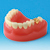 RESTAURACIÓN DENTAL / MODELO DE ESTUDIO DE PRÓTESIS [PE-PRO001]