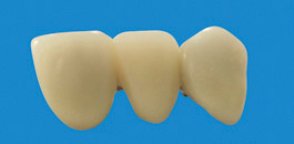 Puente de 3 Unidades PFM