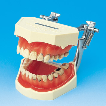 MODELO DE ESTUDIO CON CARIES [PE-TDS003]