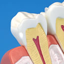 CO(defecto en forma de cuña)