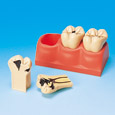 MODELO DE ESTUDIO DE CARIES DE TAMAÑO 4x [PE-TDS006]