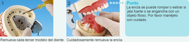 Como remover la encía