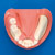 Implant Comprehensive Practice (Maxillary Jaw) [IMP1011-U-SP], (Mandibular Jaw) [IMP1012-L-SP]