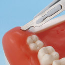 Complicated Tooth Extraction