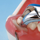 Complicated Tooth Extraction