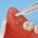 Impacted Tooth Extraction