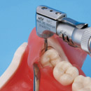 Impacted Tooth Extraction