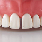 Diastema Tooth Model [A21A-UR19Y, A21A-UL19Y, A21A-UR19AE, A21A-UL19AF]