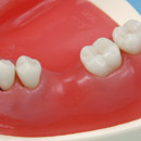 Guided Tissue Regeneration Method