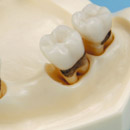 Guided Tissue Regeneration Method