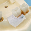 Guided Tissue Regeneration Method