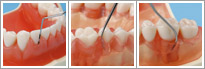 Abutment Tooth,  Cavity Preparation