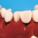 Periodontal pockets & clefts