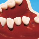 Inflamed gingiva & gingival recession
