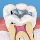 Secondary Caries