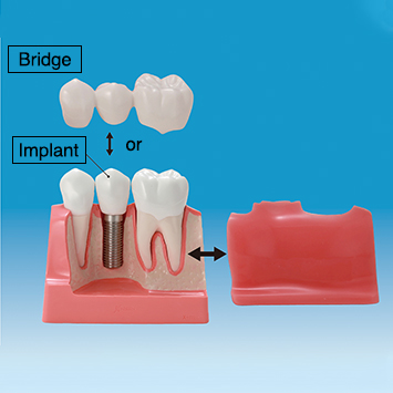 Implant vs Bridge Model [PE-IMP001]