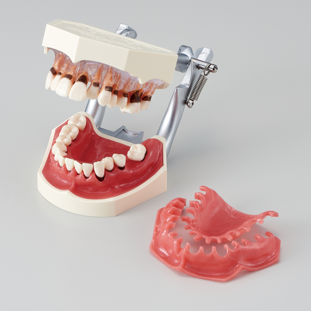 PERIODONTAL DISEASE MODEL [PE-PER001]