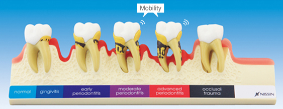 PERIODONTAL DISEASE MODEL [PE-PER010]