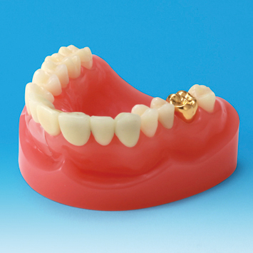 Dental Restoration/Prosthesis Study Model [PE-PRO001]