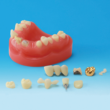 Dental Restoration/Prosthesis Study Model [PE-PRO001]