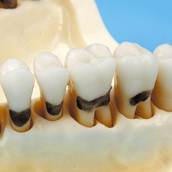 Periodontal Jaw Model [PER1001-UL-SP-FEM-32]