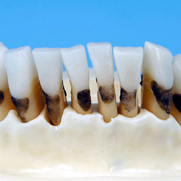 Periodontal Jaw Model [PER1001-UL-SP-FEM-32]