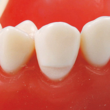 Wedge-shaped Defect Tooth Model [A25A-UL39B (#23)] [A25A-UR39E (#13)] [A25A-UR49J (#14)]