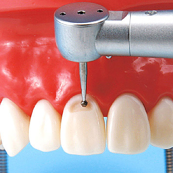 Prosthetic Restoration Jaw Model (32 teeth) [CON2001-UL-HD-FEM-32]