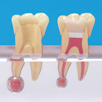 Endodontic Procedure Model [PE-END003]