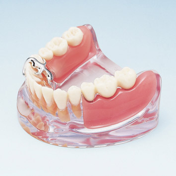 Implant & Partial Denture Model [PE-IMP002]