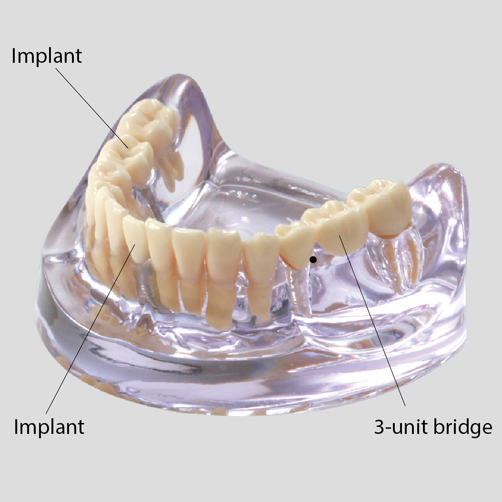 Implant vs Bridge Model [PE-IMP003]