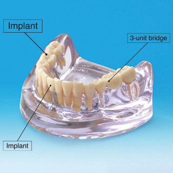 Implant vs Bridge Model [PE-IMP003]