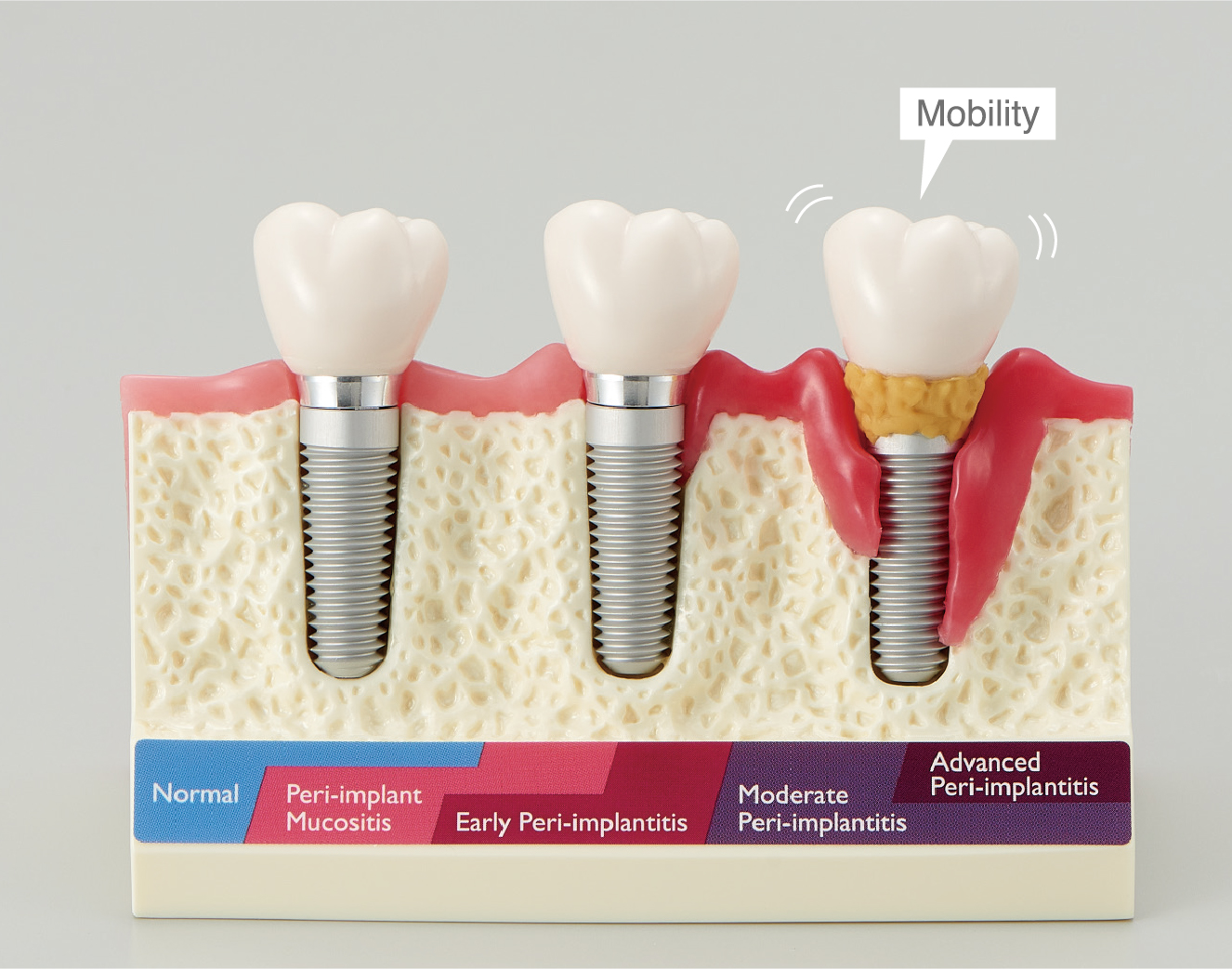 Peri-Implant Disease Model [PE-IMP004]