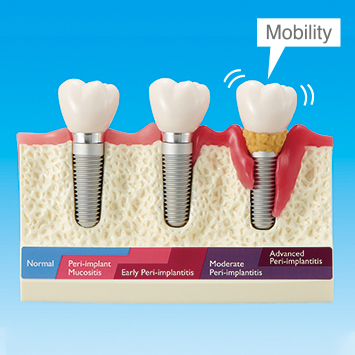 Peri-Implant Disease Model [PE-IMP004]