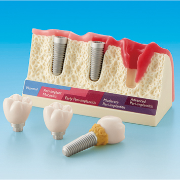 Peri-Implant Disease Model [PE-IMP004]