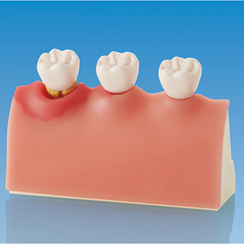 Peri-Implant Disease Model [PE-IMP004]